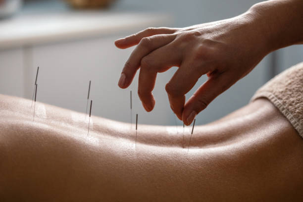 acupuncture